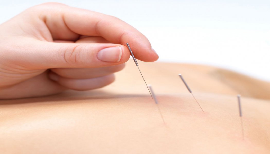 Acupuncture to reduce pain with traditional Chinese medicine