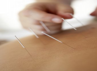 Acupuncture to reduce pain with traditional Chinese medicine_2