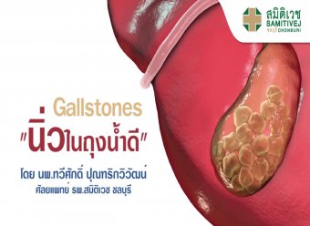 Gallstones