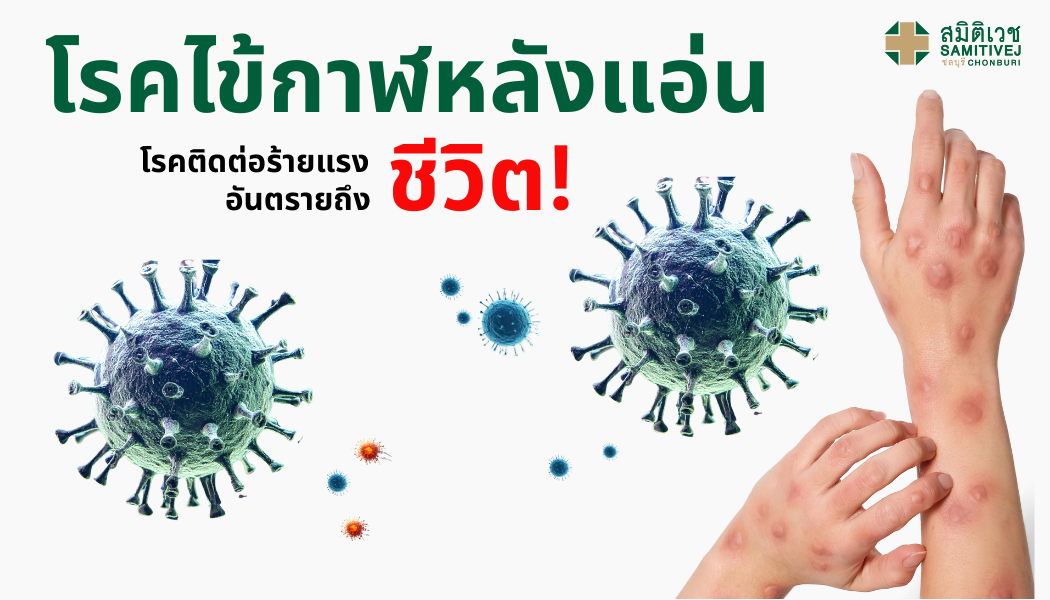 โรคไข้กาฬหลังแอ่น  (Meningococcal Disease)โรคติอต่อร้ายแรงอันตรายถึงชีวิต