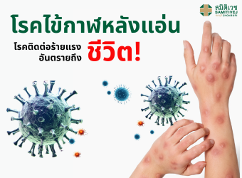 โรคไข้กาฬหลังแอ่น  (Meningococcal Disease)โรคติอต่อร้ายแรงอันตรายถึงชีวิต_2