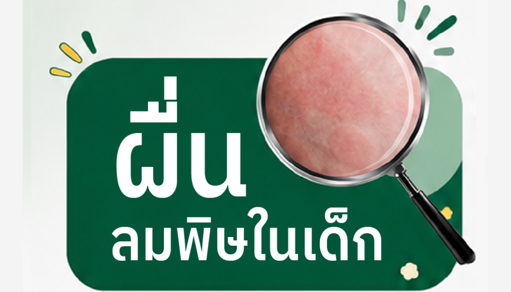 ผื่นลมพิษในเด็ก