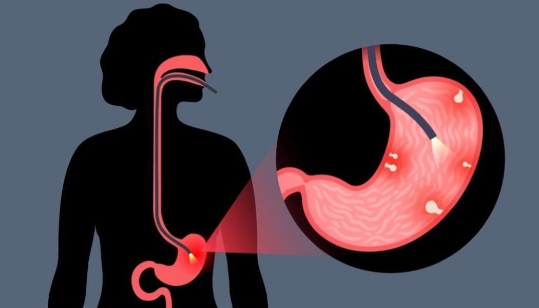 ส่องกล้องกระเพาะอาหาร (Gastroscopy) ตรวจหาโรคอะไร เจ็บไหม ?