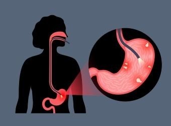 ส่องกล้องกระเพาะอาหาร (Gastroscopy) ตรวจหาโรคอะไร เจ็บไหม ?_2